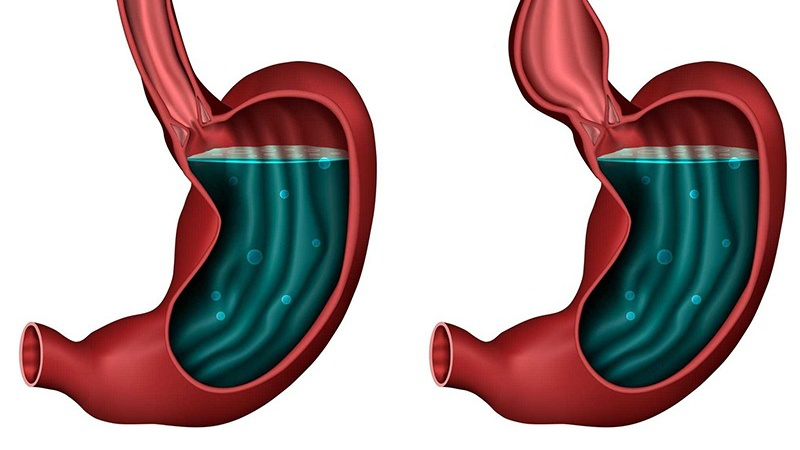 Một số phẫu thuật điều trị co thắt tâm vị 1