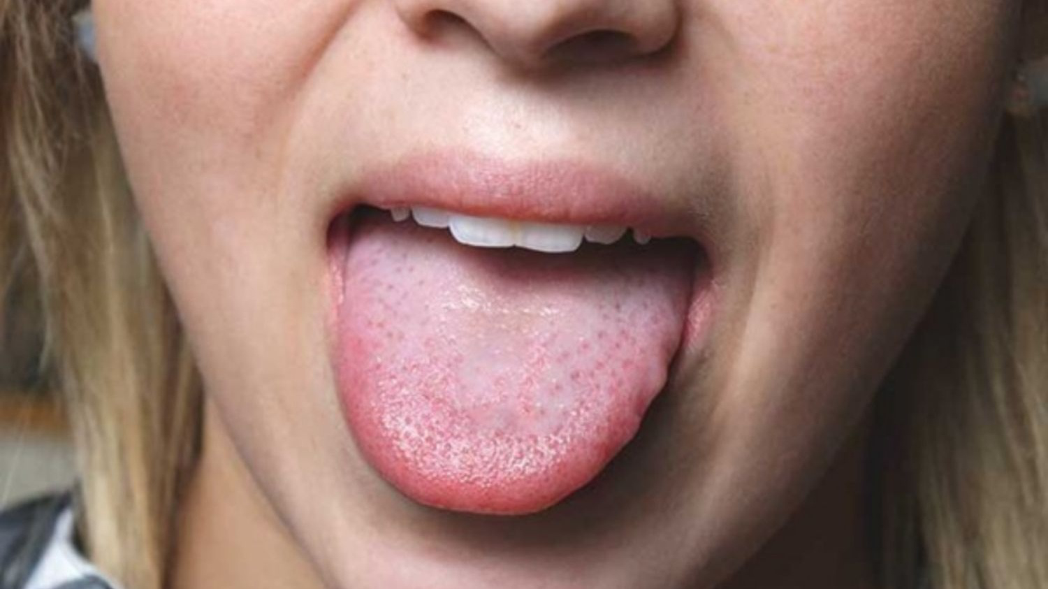 Có thể tự điều trị lưỡi nổi mụn thịt không?
