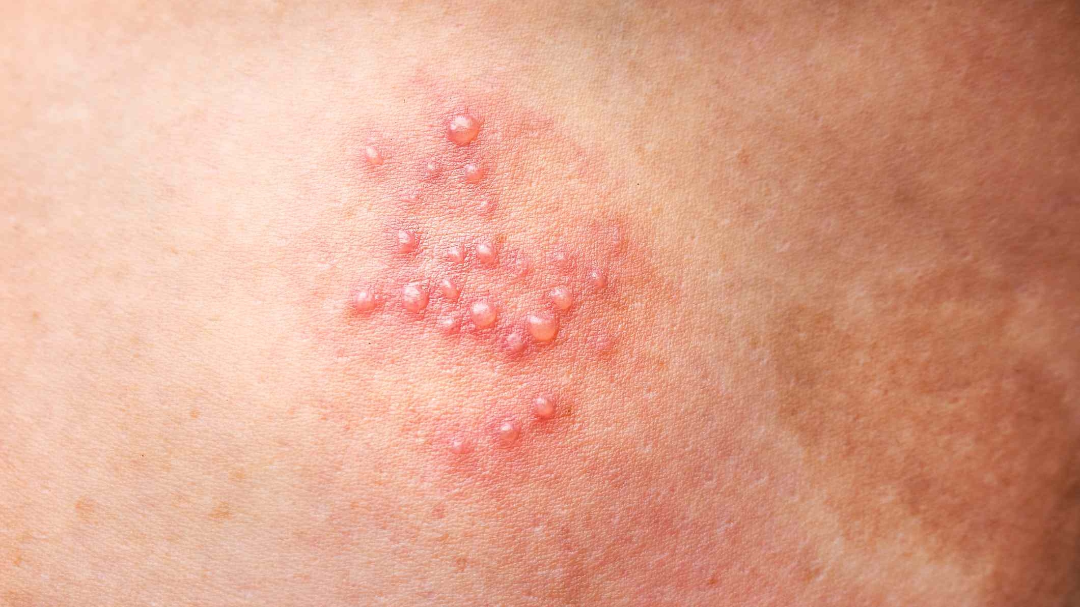 Herpes sinh dục ở nam | G3VN