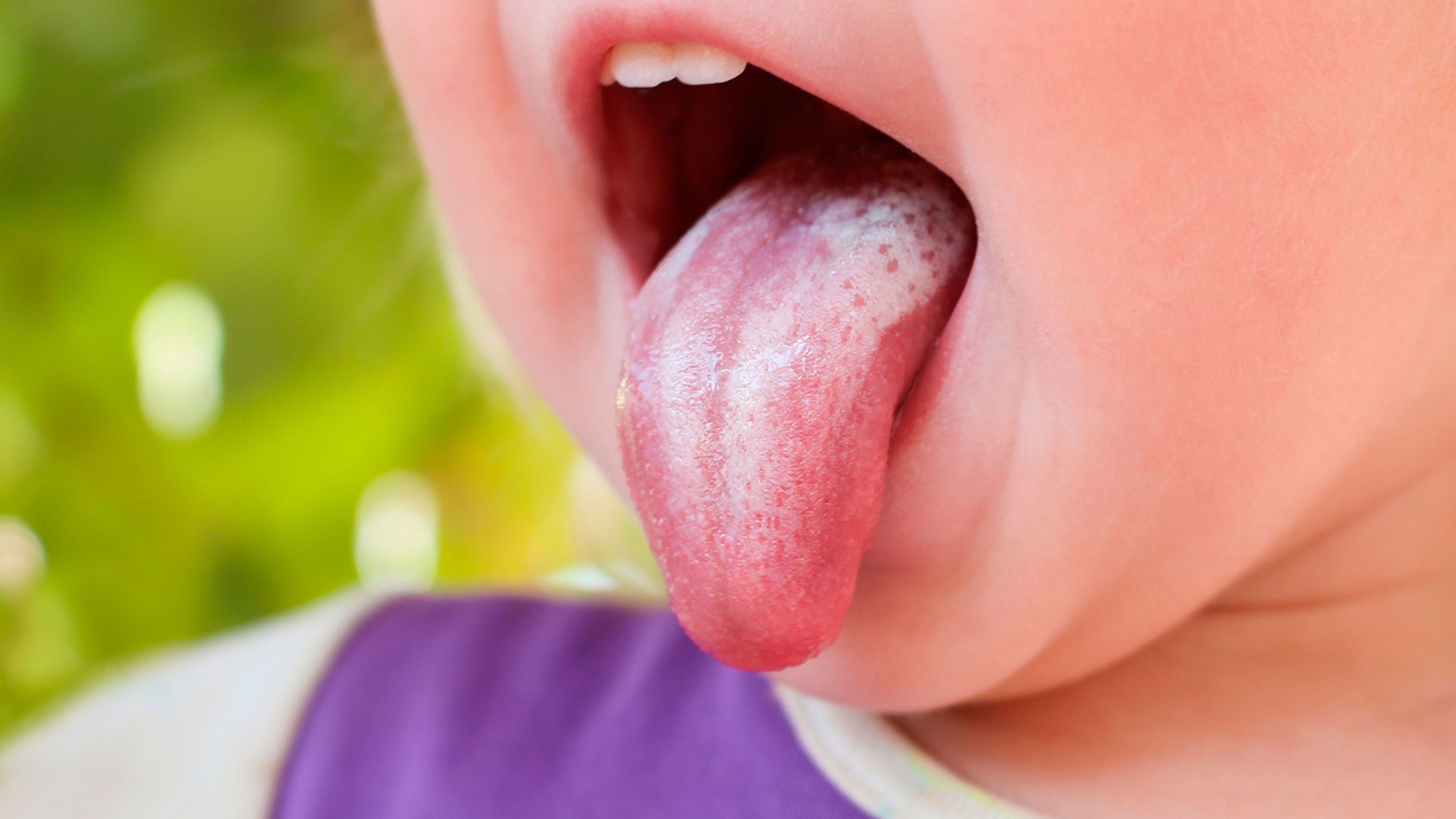 Các triệu chứng hay dấu hiệu của trẻ bị nấm miệng là gì?
