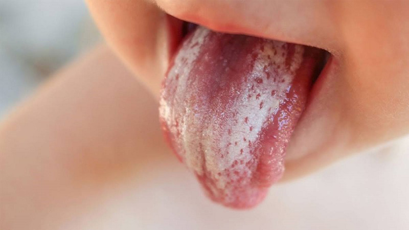 Nấm lưỡi ở trẻ: Nguyên nhân, triệu chứng và cách điều trị 1