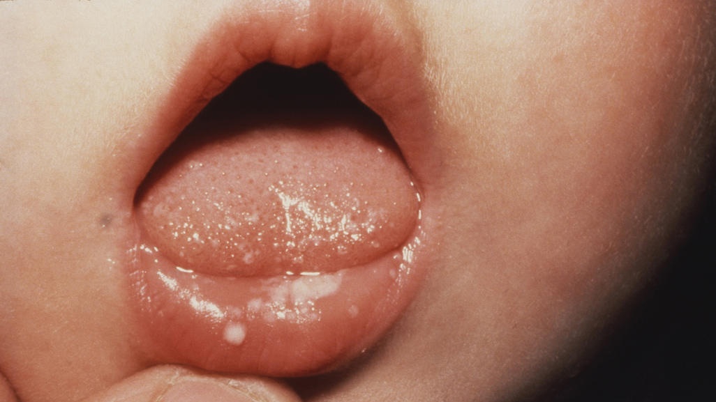Nấm miệng ở trẻ sơ sinh có thể tái phát không?