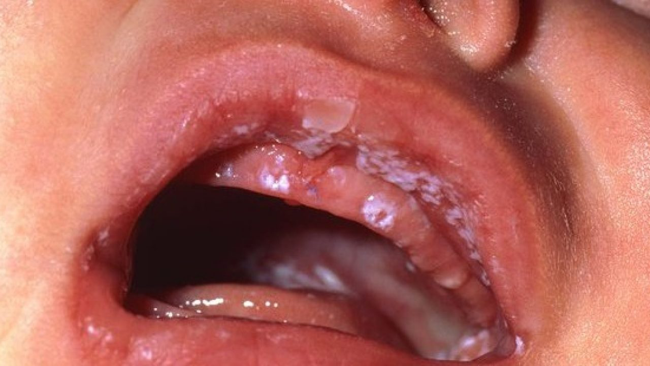 Làm thế nào để phòng ngừa nấm miệng?
