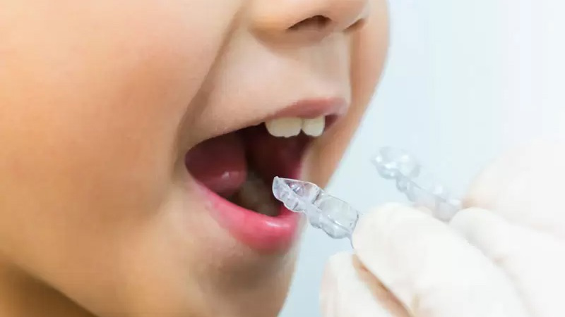 Phương pháp nắn chỉnh răng cho trẻ em có thể bạn chưa biết 4