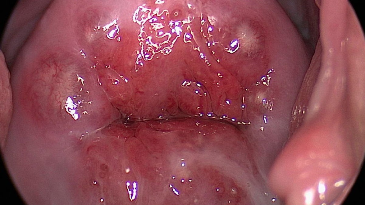 Nang Naboth Cổ Tử Cung 5mm: Triệu Chứng Và Phương Pháp Điều Trị