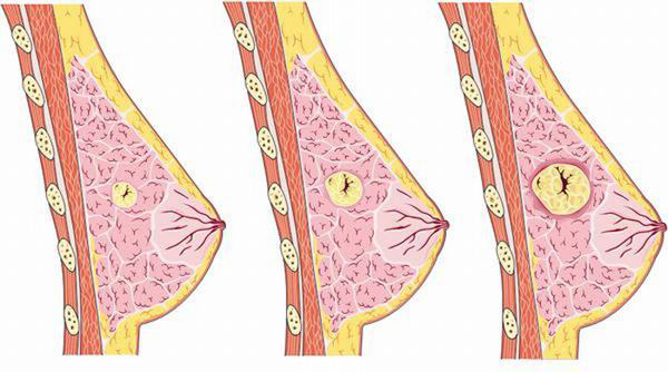 Nang tuyến vú birads 3 là gì? Có nguy hiểm không?  2