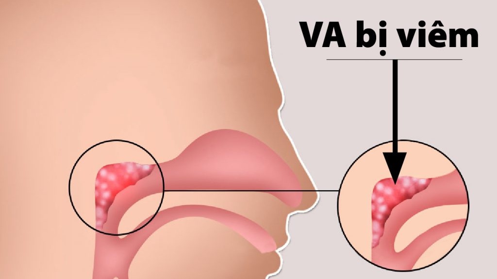 Khi nào cần nạo VA và cắt amidan cho trẻ? Cách chăm sóc sau nạo VA và cắt Amidan