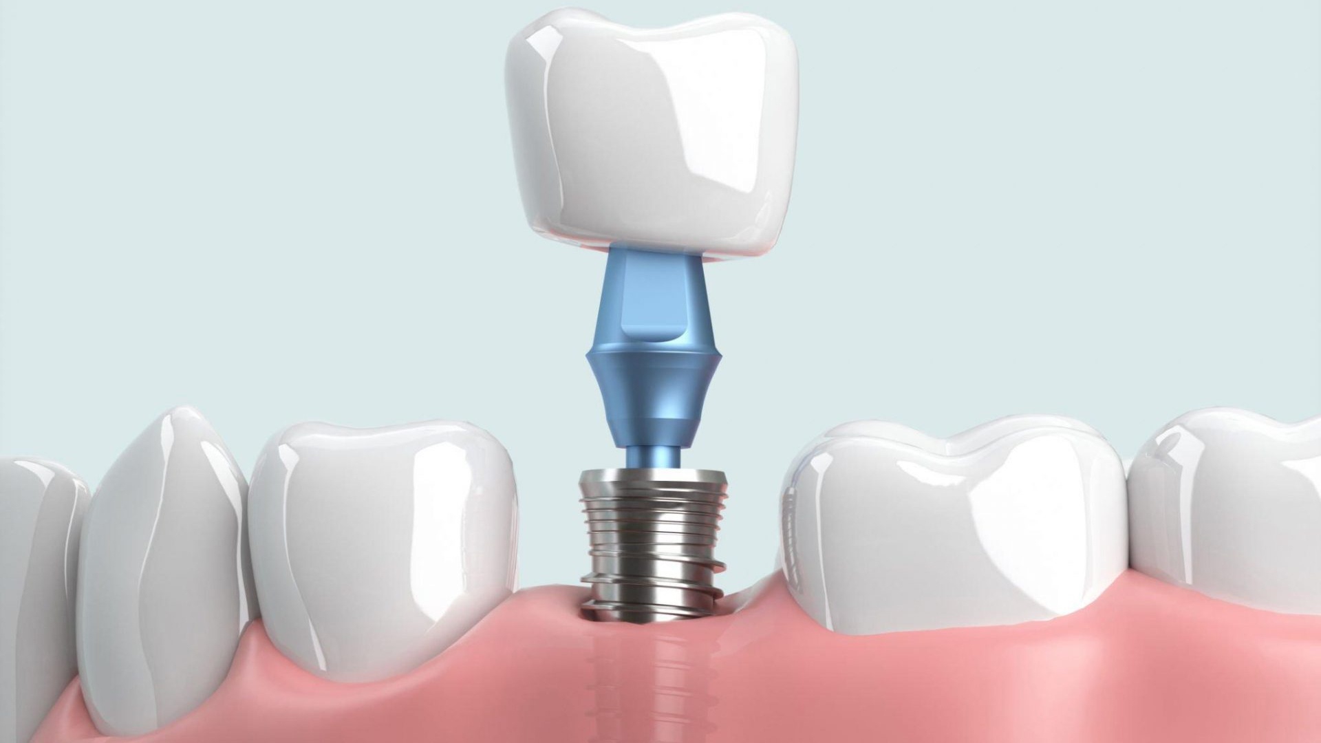 Nên chọn kích thước trụ implant như thế nào?