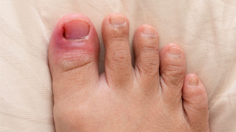 Khoé móng chân bị sưng đau là triệu chứng của bệnh gì?
