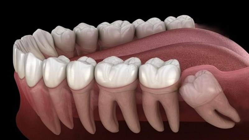 Nên nhổ răng khôn vào lúc nào? Bật mí thời điểm lý tưởng 1