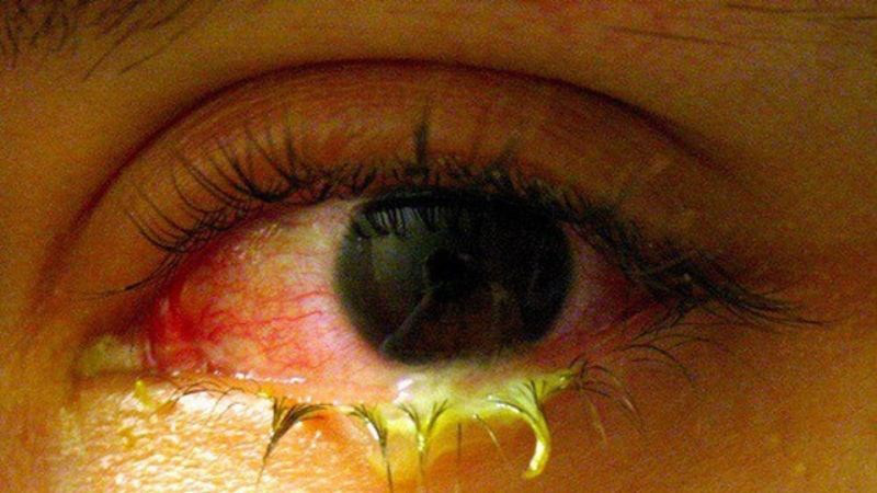 Ngủ dậy mắt bị ghèn nhiều cảnh báo bệnh gì? 3