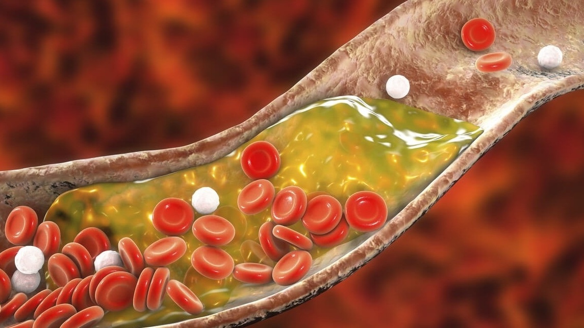 Máu nhiễm mỡ có ảnh hưởng đến khả năng hiến máu không?