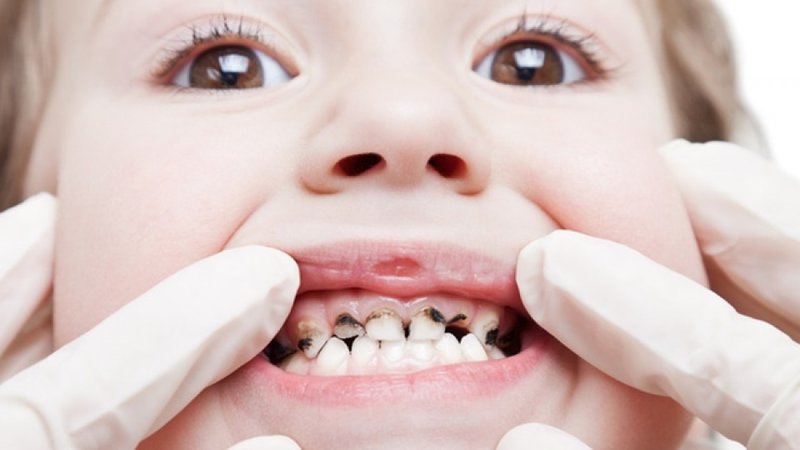 Các bệnh lý về răng miệng hay gặp ở trẻ em 18 tháng tuổi là gì?
