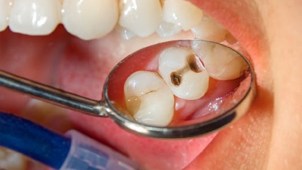 Sâu răng hàm có lỗ có thể ảnh hưởng đến sức khỏe tổng thể không?

