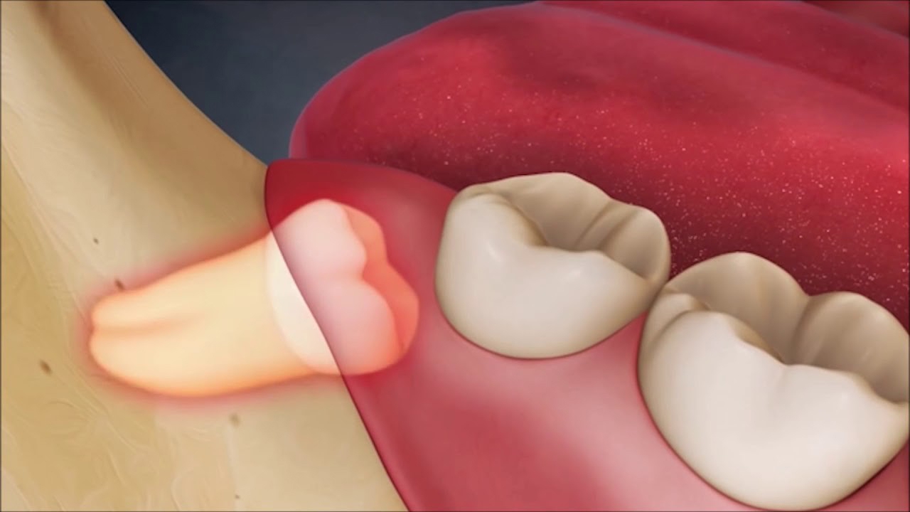 Sâu răng có thể gây ra sốt đau răng?
