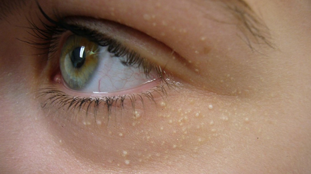 Các vết thương da hoặc kích ứng da có thể gây mụn thịt quanh mắt?

