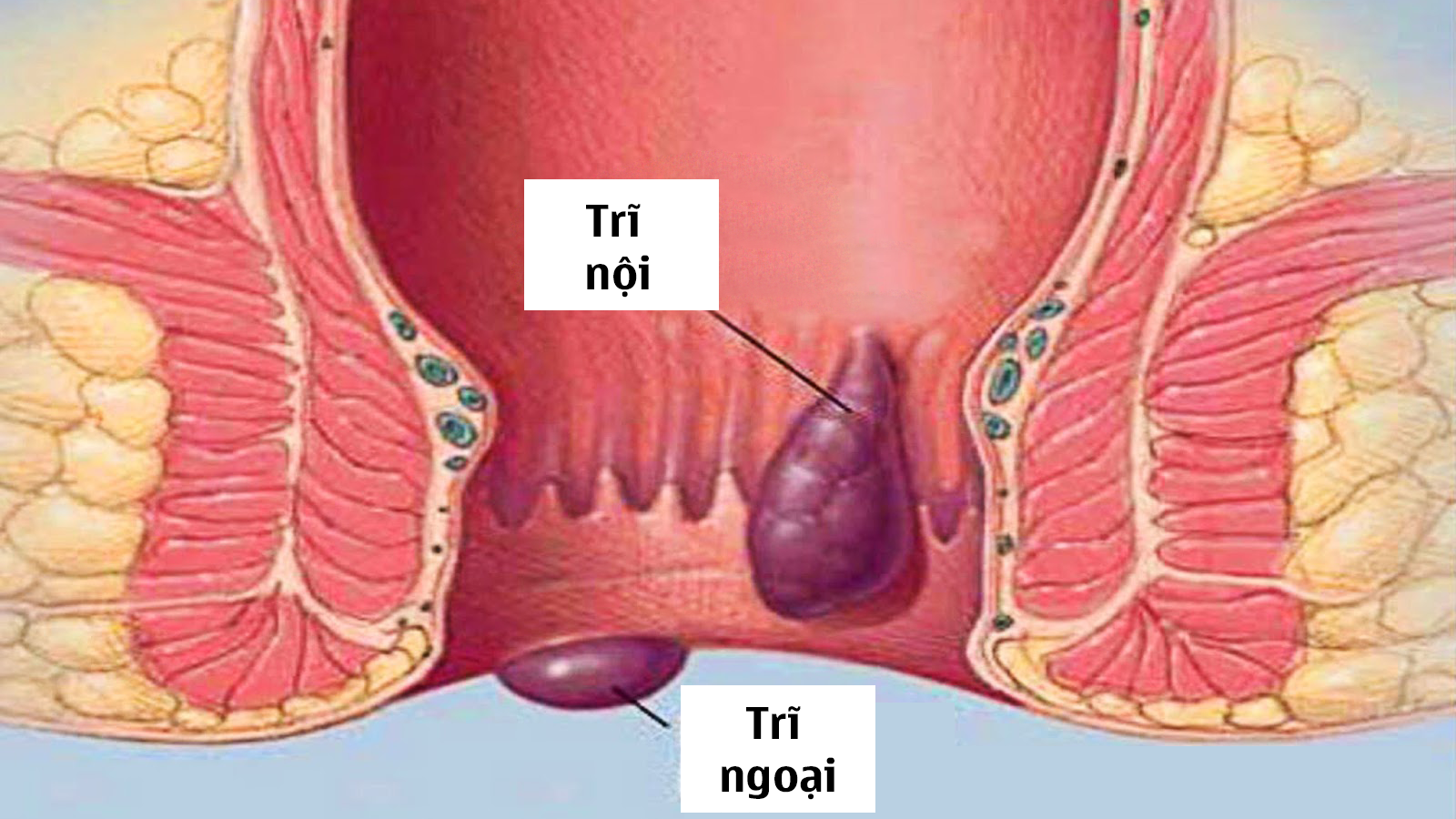 Nguyên nhân gây nên bệnh trĩ là gì?