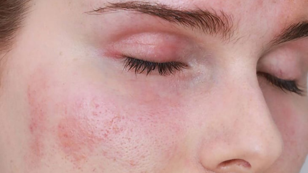 Cách chăm sóc da khi bị nổi mề đay mặt và ảnh hưởng đến sức khỏe