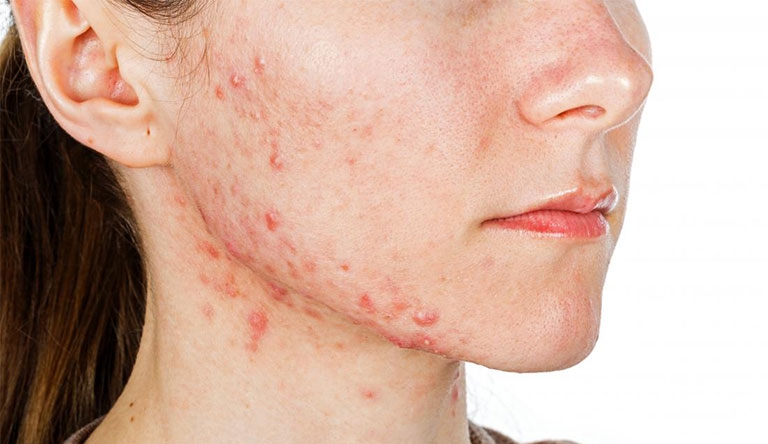 Những nguyên nhân khác ngoài vệ sinh da có thể làm nổi mụn ở cổ?
