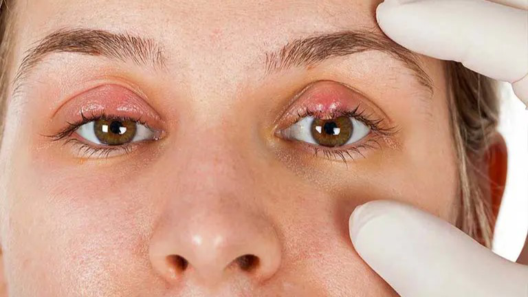 Sưng mắt, một số nguyên nhân và phương pháp khắc phục