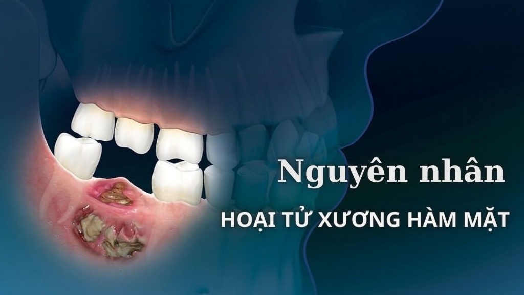 Nguyên nhân hoại tử xương hàm mặt và cách chữa trị