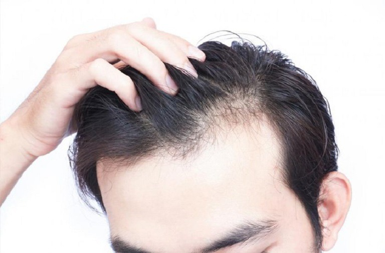Trán cao để tóc gì nam? Thử 7+ kiểu tóc nam che khuyết điểm