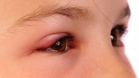 Mắt bị sưng và chảy nước mắt là triệu chứng của những bệnh gì?
