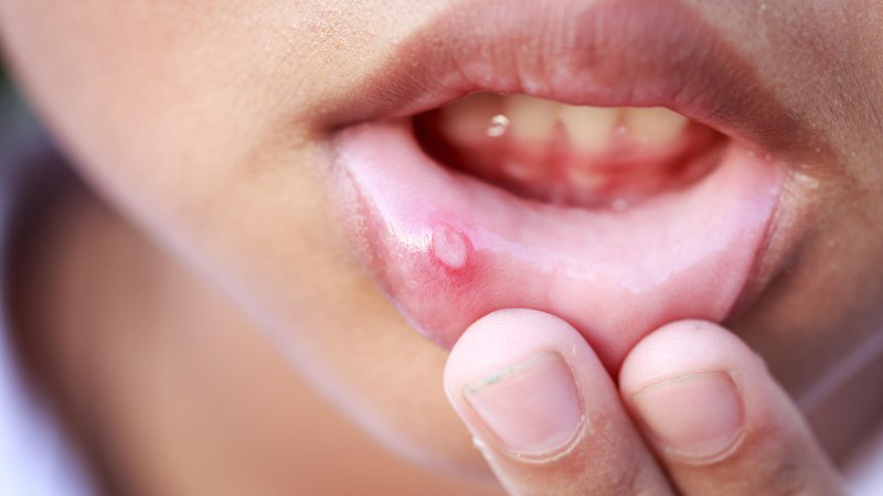 Nguyên nhân lưỡi nổi hạt trắng và cách điều trị 1