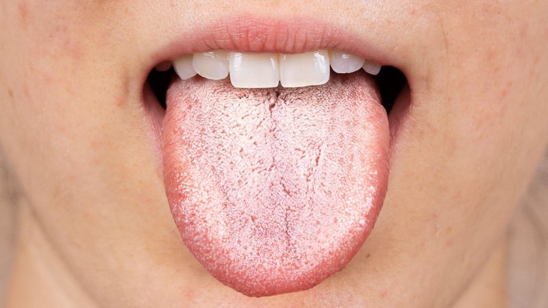 Nguyên nhân lưỡi nổi hạt trắng và cách điều trị 2