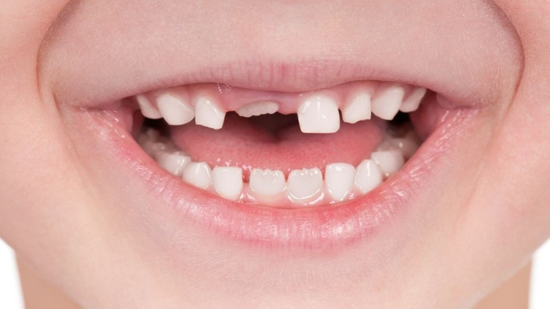 Làm thế nào để nhận biết răng mọc lẫy ở trẻ em?
