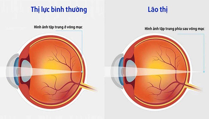 nguyen-nhan-tai-sao-nguoi-gia-thuong-phai-deo-kinh-lao-1.jpg