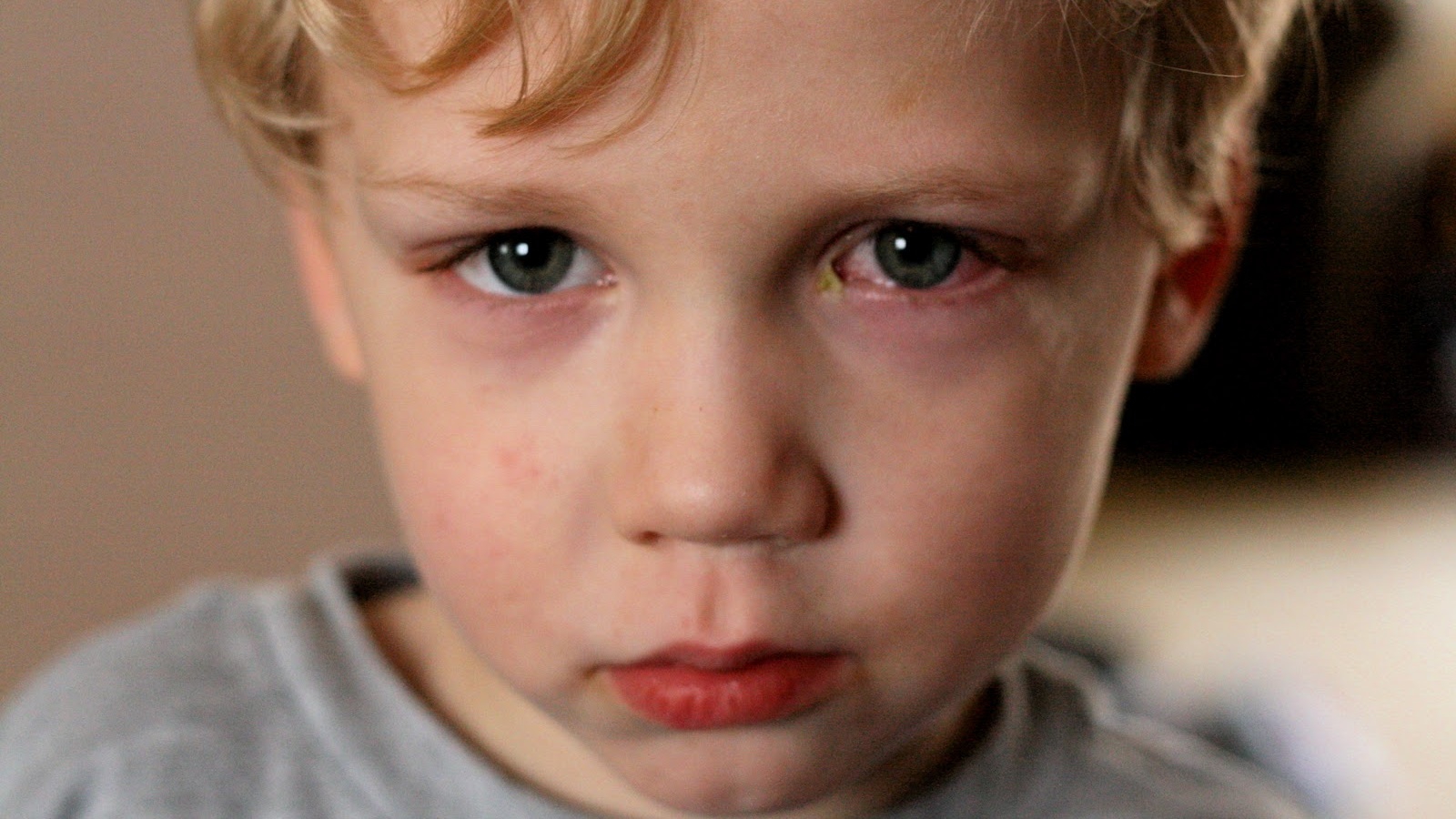 Mắt bé bị sưng đỏ mí dưới là triệu chứng của vấn đề gì?
