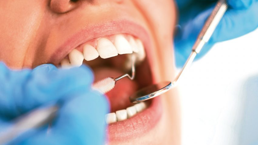 Đau đầu sau khi nhổ răng khôn có thể kéo dài trong bao lâu?
