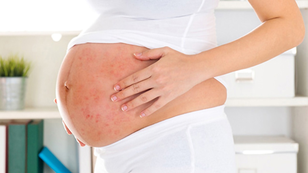 Nguyên nhân và dấu hiệu của tình trạng nổi mề đay khi mang thai