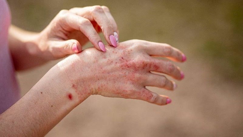 Các bệnh về da mùa hè thường gặp và cách phòng ngừa - Nhà thuốc FPT Long  Châu
