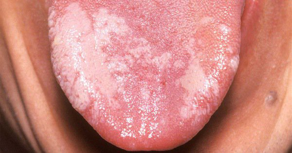 Nguyên nhân và triệu chứng gây bệnh bạch sản niêm mạc miệng 1