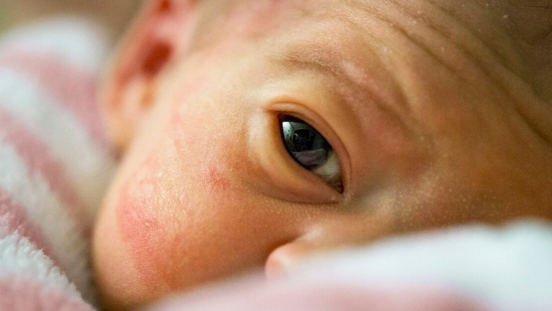Dấu hiệu bệnh bạch biến ở trẻ sơ sinh