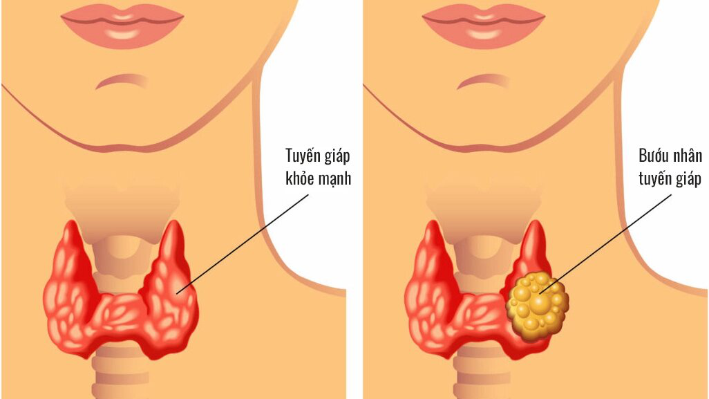 Nhân tuyến giáp có nguy hiểm không?