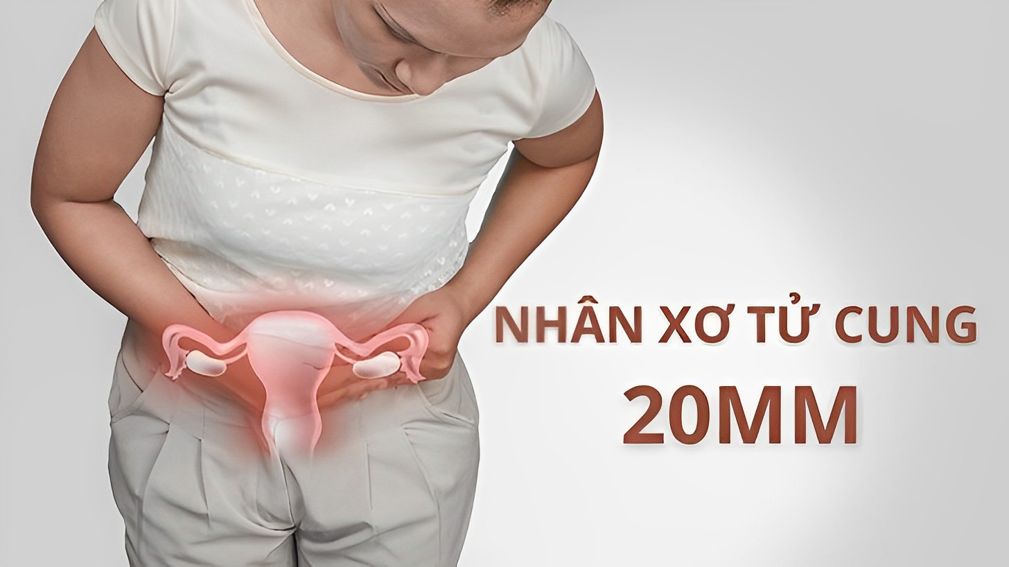 Nhân xơ tử cung 20mm có nguy hiểm không? Cách chữa như thế nào?