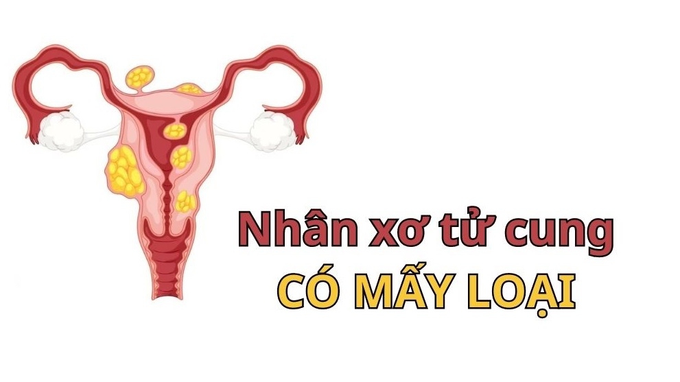 Nhân xơ tử cung có mấy loại? Các loại khác nhau như thế nào?