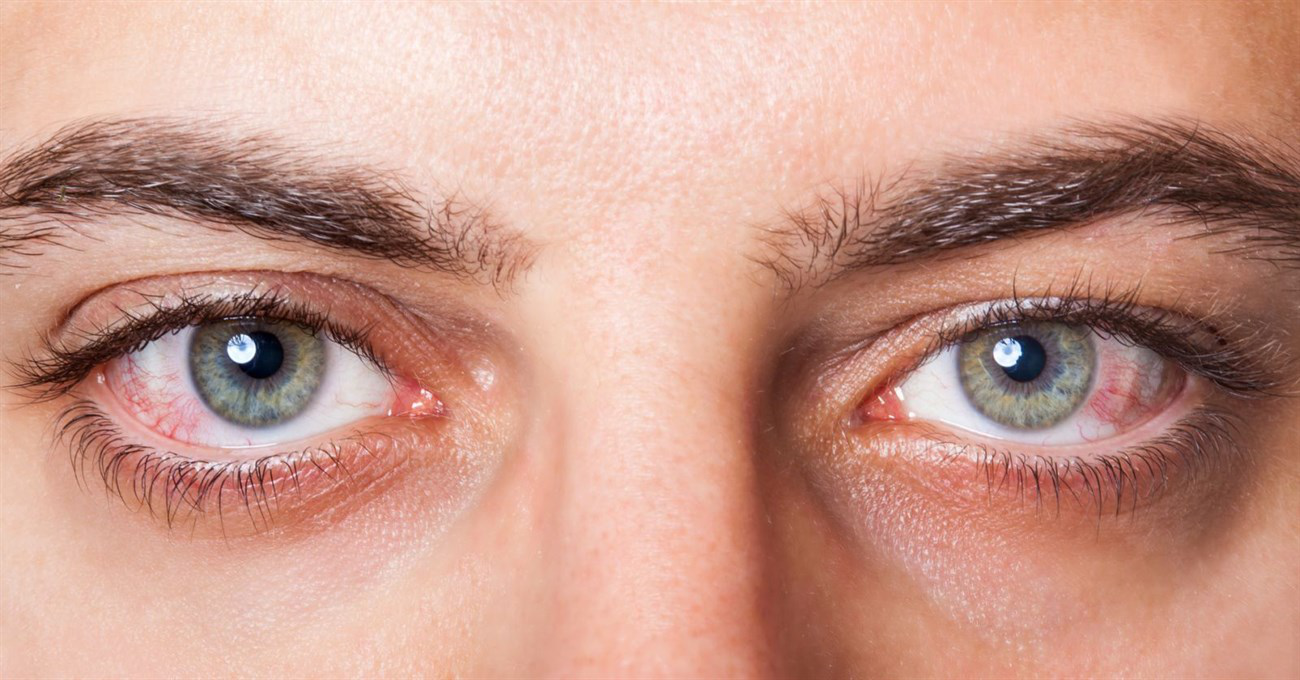 Ký sinh trùng trong mắt có thể lây lan như thế nào?
