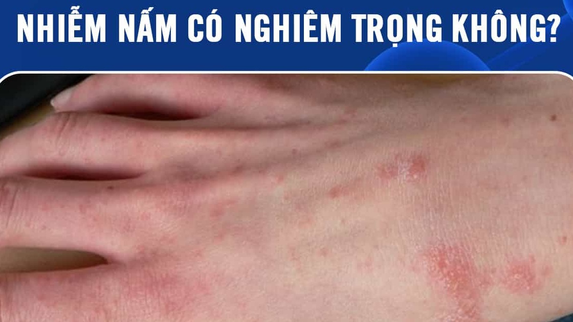 Nhiễm nấm có nghiêm trọng không?