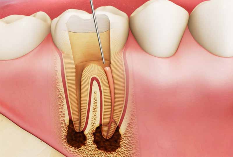 Nhiễm trùng răng: Nguyên nhân và các dấu hiệu nhận biết 1