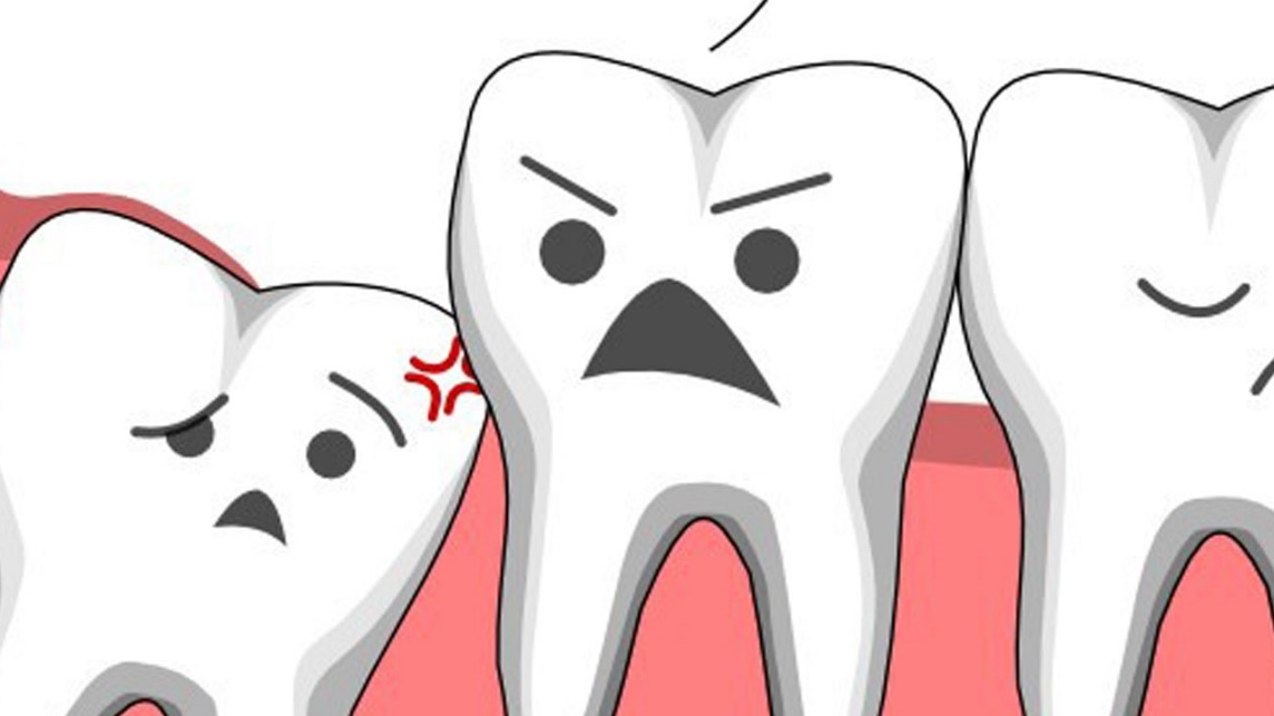 Khi nào là thời điểm thích hợp để nhổ 2 răng khôn?

