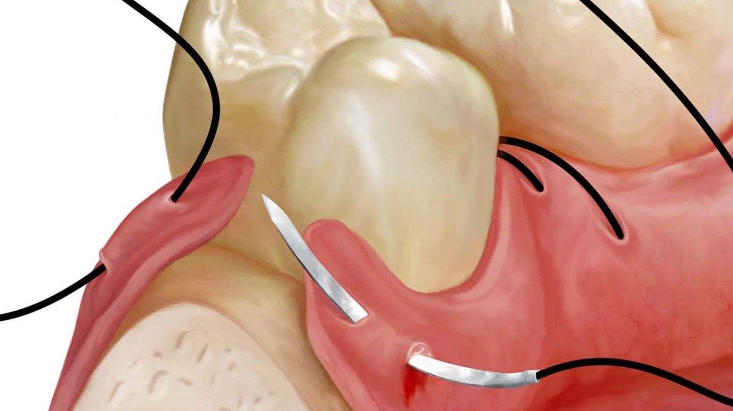 Nhổ răng khôn mấy ngày cắt chỉ?