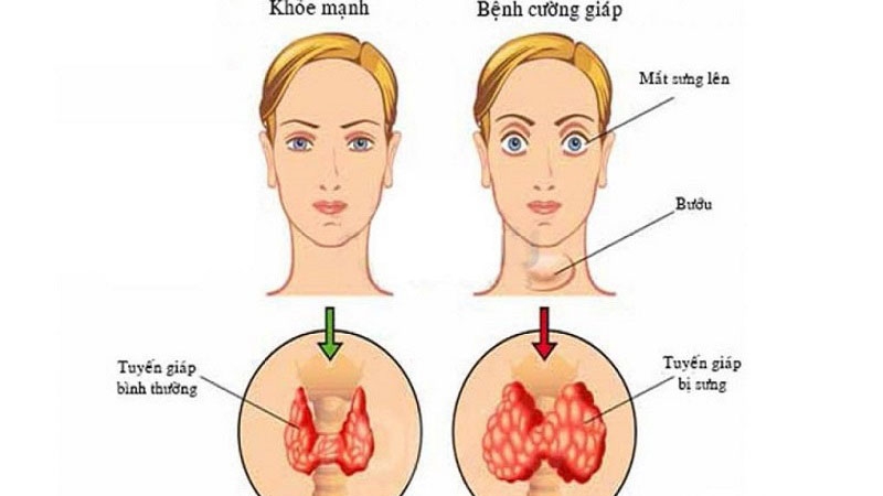 Những ai cần xét nghiệm tuyến giáp khi mang thai? 3