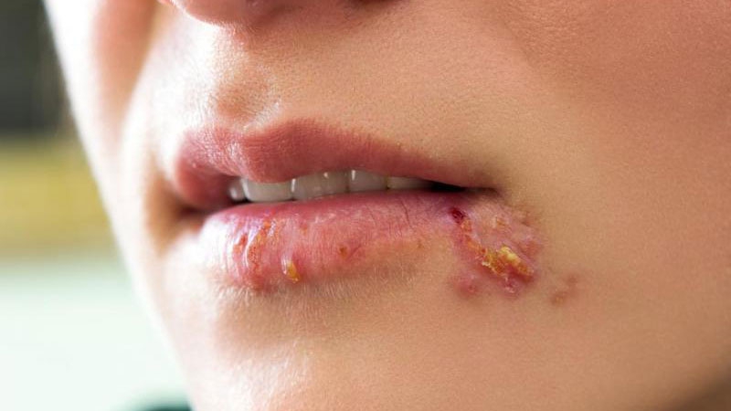 Những bài thuốc Đông y chữa bệnh giang mai ở nam và nữ hiệu quả