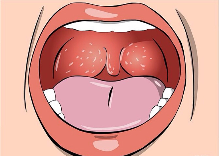 Hạt trắng trong khoang miệng có liên quan đến vấn đề viêm họng không?
