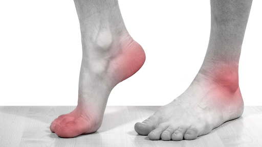 Bệnh gút ở chân có thể ảnh hưởng đến khả năng di chuyển của người mắc bệnh không?
