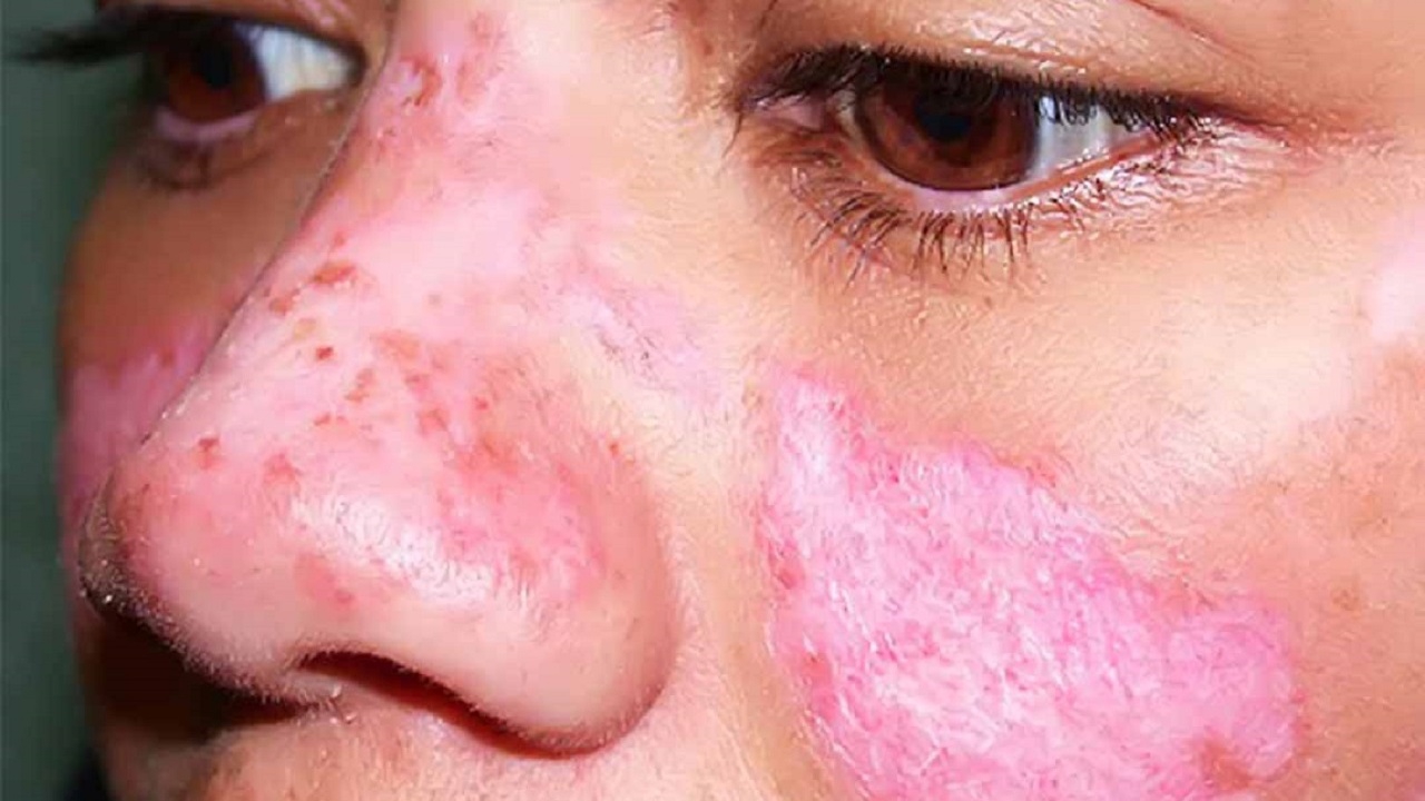 Những điều cần biết về lupus ban đỏ hệ thống bệnh học